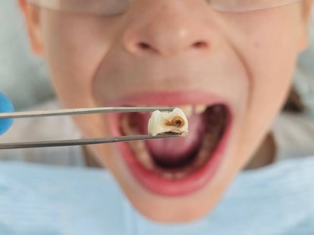 Best Emergency Treatment for Dental Infections or Abscesses in Twin Falls, ID